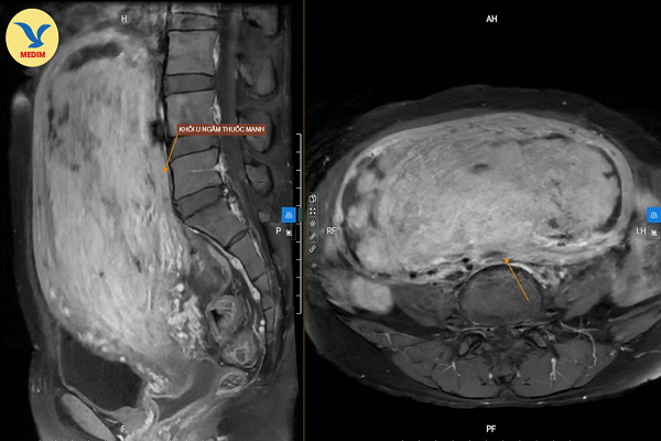Phát hiện khối u “khủng” 18 cm khi thăm khám tại MEDLATEC